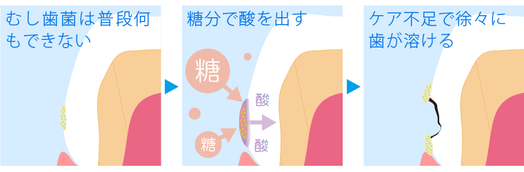 むし歯になる流れ